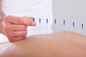 Acupuncture Therapy